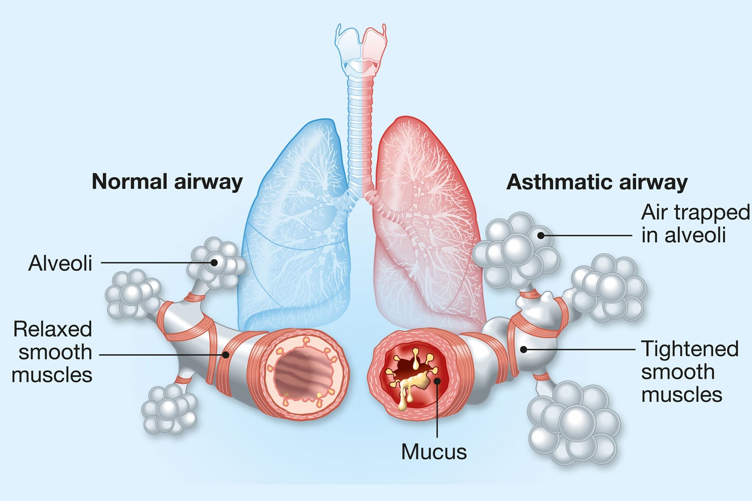Diagram showing Asthma, normal and asthmatic airways