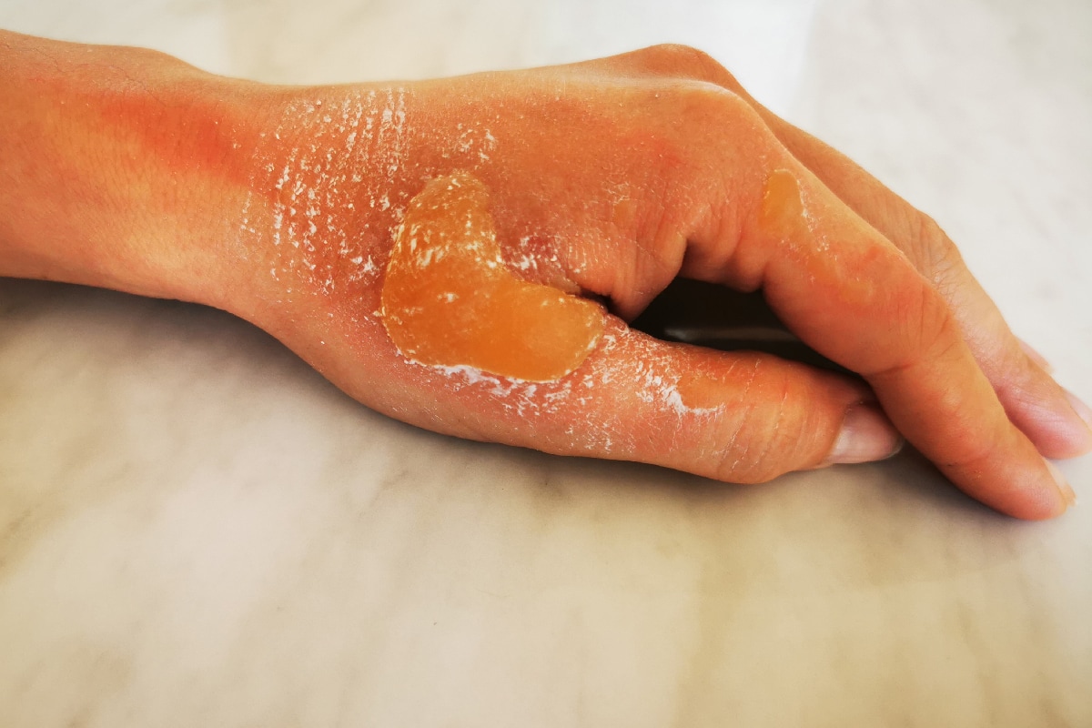 Patient's hand and thumb with heat blister and injuries